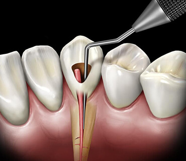 Endodonti (Kanal Tedavi)